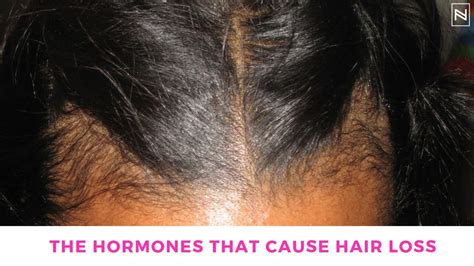 With age, the ovaries begin to decrease the amount of sex hormones that are normally produced. Can a Hormonal Imbalance Cause Hair Loss? | Hormonal Hair ...