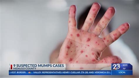 Nine Suspected Mumps Cases