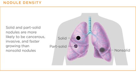 Lung Nodules Lungevity Foundation