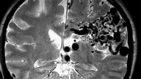 Best Treatment For Unruptured Brain Avms At Present May Be Medical