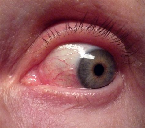 Conjunctivitis Allergic Infectious Or Chemical