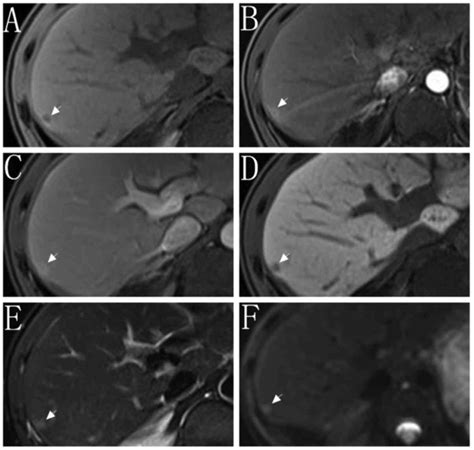 Performance Of Gd‑eob‑dtpa‑enhanced Mri For The Diagnosis Of Li‑rads 4