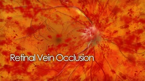 A Patient Guide To Retinal Vein Occlusion