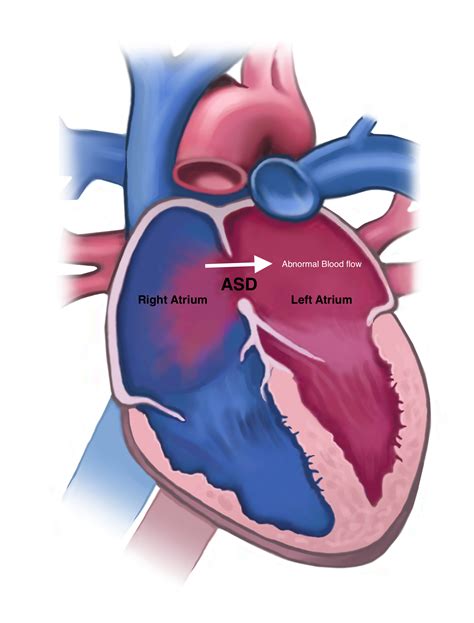 Atrial Septal Defect Keyhole Heart Clinic