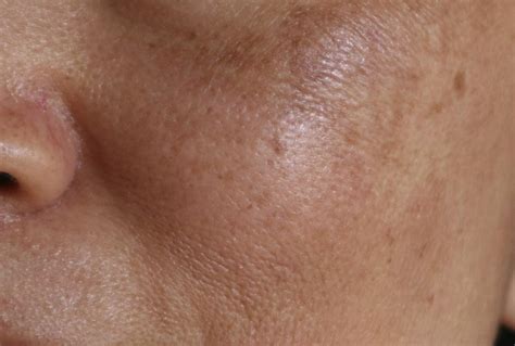 Exploring The Differences Between Freckles And Melasma Justinboey