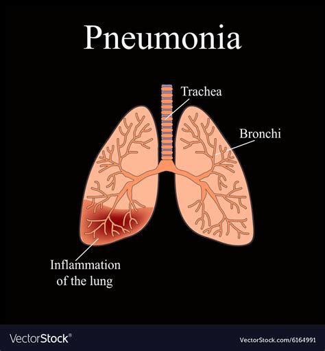 Pneumonia The Anatomical Structure Of Human Vector Image