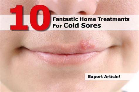 10 Fantastic Home Treatments For Cold Sores