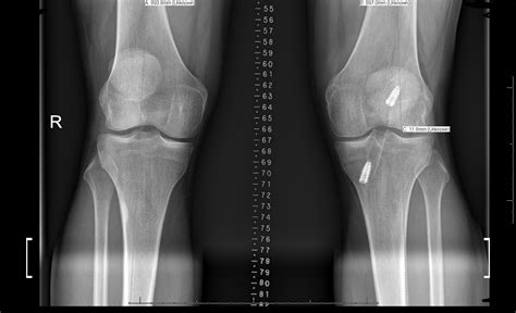 Articular Cartilage Defects Of Knee Knee And Sports Orthobullets