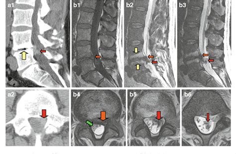 Chronic Dura Erosion And Intradural Lumbar Disc Herniation CT And MR Imaging And Intraoperative