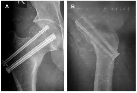Malunion In Displaced Intracapsular Fracture Of Femoral Neck A Rare