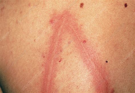 Dermatographism Urticaria On Skin Of A Young Man Stock Image M320