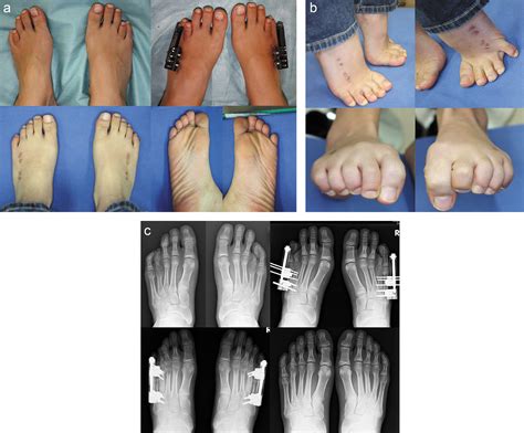 Nonincisional Osteotomy For Gradual Lengthening By Callus Distraction For Congenital