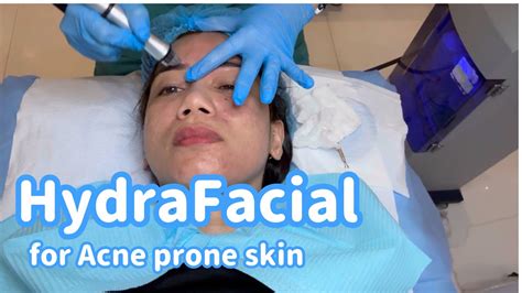 Hydrafacial Treatment For Oily And Acne Prone Skin The Rhonzie Vlog