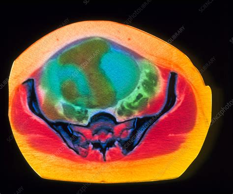 Ovarian Cancer Ct Scan Stock Image M8500372 Science Photo Library