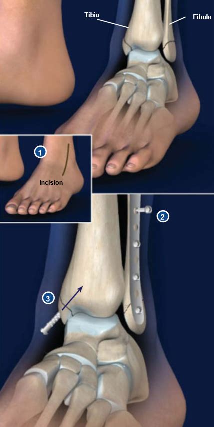 Ankle Fracture Surgery Central Coast Orthopedic Medical Group