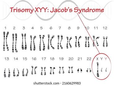 Jacobsen Syndrome Karyotype