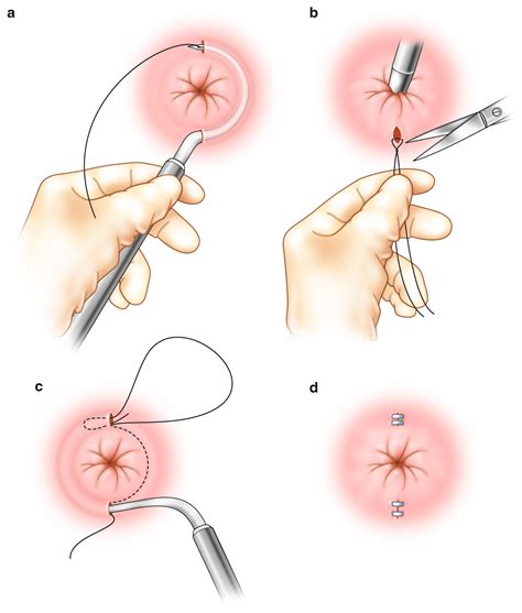 Thiersch Wiring Use In Rectal Prolapse Rectal Prolapse Rectal Surgery