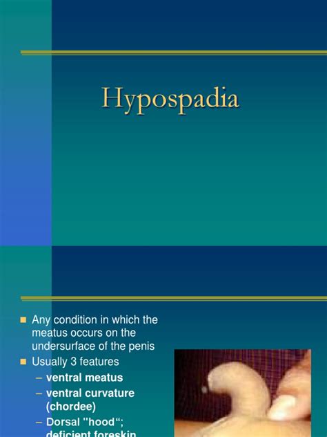 Hypospadias Sdc Pdf Sexual Anatomy Medical Specialties