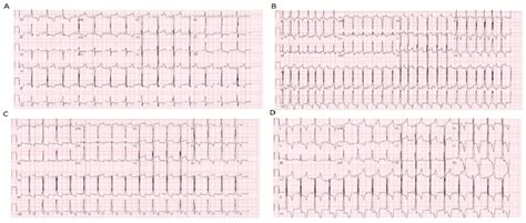 Hospitalization Electrocardiograms Ekgs Download Scientific Diagram