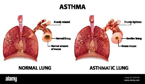 Comparison Of Healthy Lung And Asthmatic Lung Illustration Stock Vector