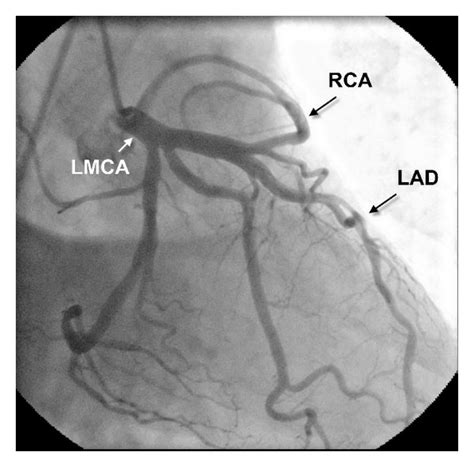 A Right Anterior Oblique View With Caudal Angulation The Rca