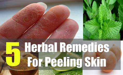 5 Best Herbal Remedies For Peeling Skin Natural Home Remedies