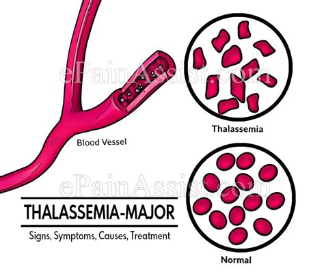 Thalassemia Signs And Symptoms