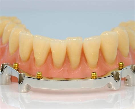 Ot Cap Attachments Partial Dentures Functional Restorations Rhein83
