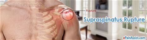 Supraspinatus Rupture Treatment Causes Symptoms Diagnosis