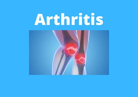 Arthritis Types Causes Symptoms And Treatment