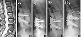 4 Level Cervical Fusion Recovery Pictures