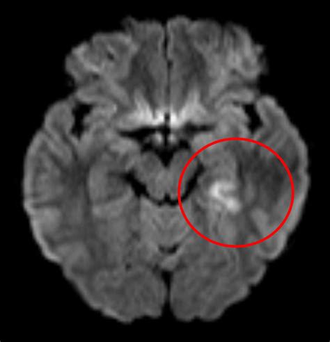 Diffusion‐weighted Imaging Of Brain Magnetic Resonance Imaging Showed