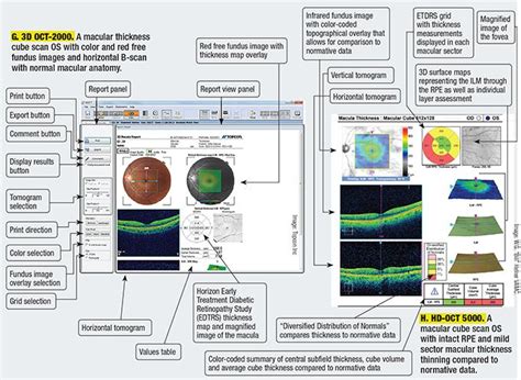 Thousands of highlighted, labeled illustrations and diagrams await! The Anatomy of an OCT Scan | Overlays, Anatomy, Coding