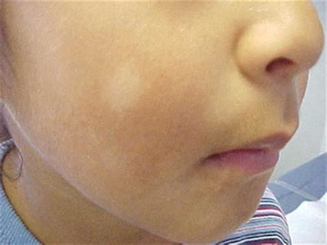 علاج البقع البيضاء على الأظافر عند الأطفال