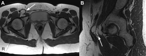 Preoperative Magnetic Resonance Images Showing A Paralabral Cyst