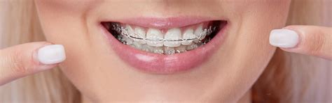 Clear Braces In Dover Nh Belknap Dental Associates
