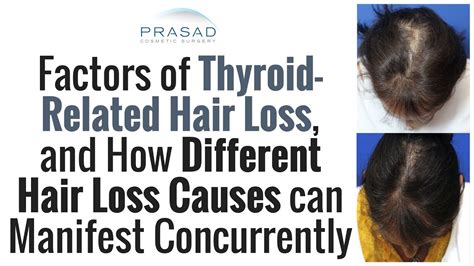 Why Thyroid Related Hair Loss Should Be Treated After Thyroid And
