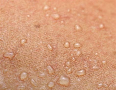 Germs May Play Key Role In Wound Induced Skin Cancer