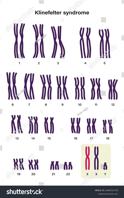 Human Karyotype Klinefelter Syndrome Klinefelters Ks Stockvector