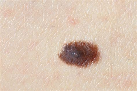 The Different Types Of Skin Cancer The Dermatology Center Of Indiana