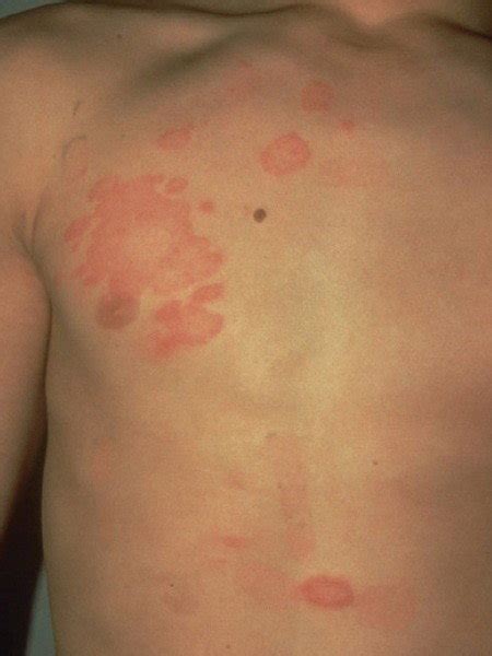 Fungal Infections Of The Skin Dermatologist In Savannah Ga Georgia