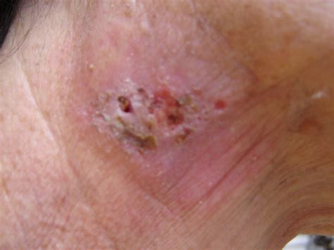 The biggest issue with throat cancer is its detection which usually occurs in advanced stages and this late detection also reduces the effects of the treatment. Cansema / CanSupport Testimonials for 2007-2009 - Alpha ...
