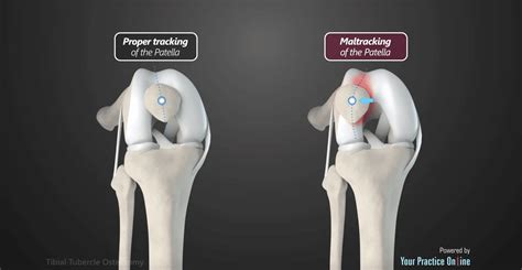 Tibial Tubercle Osteotomy Michigan Knee Institute