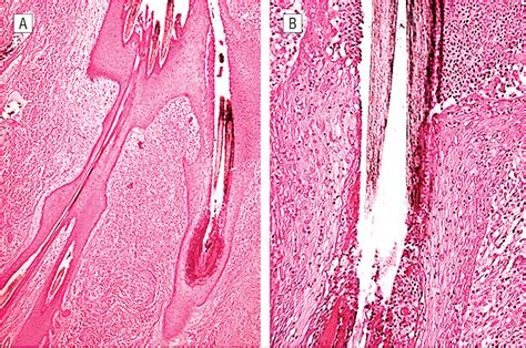 Tufted Folliculitis Of The Scalp And Treatment With Cyclosporine Hair