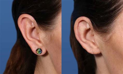 Macrotia Ear Reduction Surgery San Diego Ca