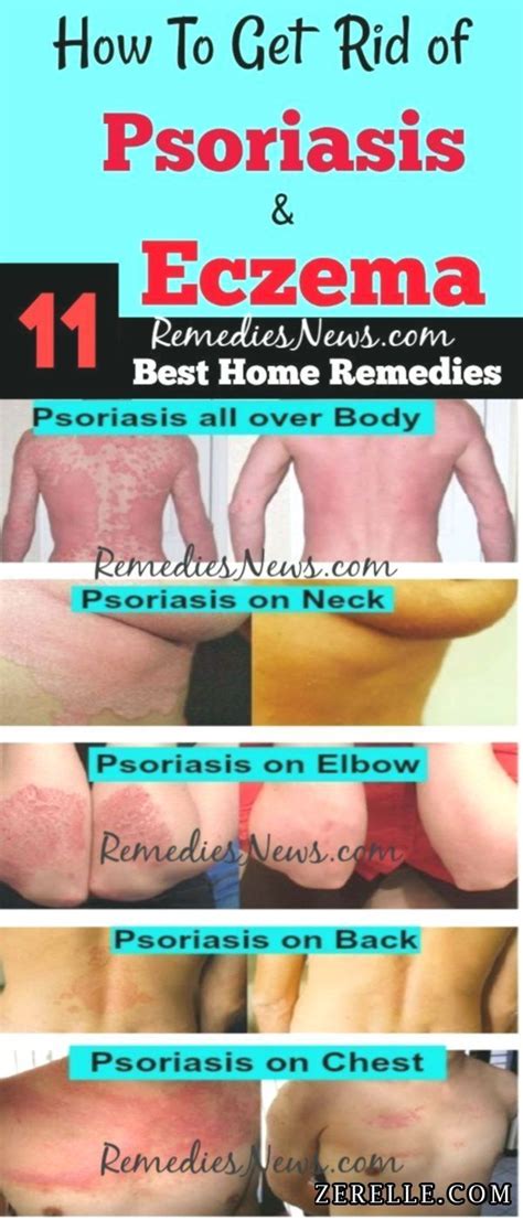 Pin By Tyler Young On Psoriasis Cure Psoriasis Cure Psoriasis Scalp