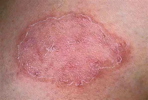 Ringworm Rash On Buttocks