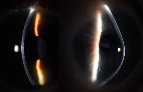 Keratoconus