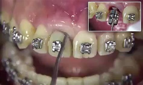 Is This Really The Painless Way To Remove Teeth Gruesome Footage Is