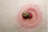 Lyme Disease Rash Itch Treatment Images
